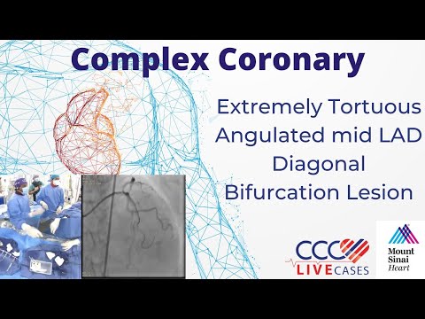 Extremely Tortuous Angulated mid LAD Diagonal Bifurcation Lesion