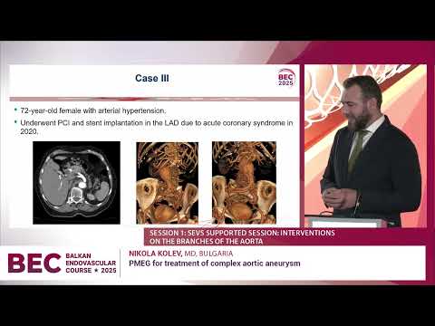 BEC 2025  PMEG for treatment of complex aortic aneurysm ⋆ Nikola Kolev