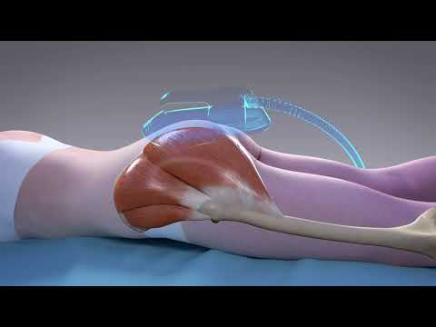 Non-Surgical Butt Lift with EMSculpt