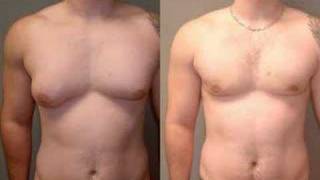 Dr Blau - Gynecomastia Surgery cost- Severe - Male Breast Reduction  - Male Breast Treatment Cost