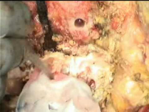 Ginocchio artrosi articolari e artrite è la differenza La curvatura delle gambe articolazioni