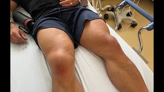 I tore my quad today