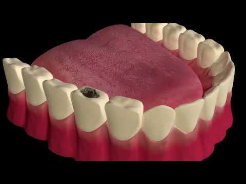 Hampaan paikkaaminen