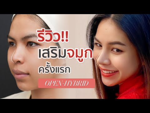 รีวิวเสริมจมูก ทรงญาญ่า — เทคนิค Open Hybrid
