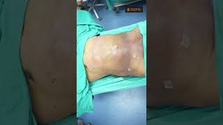 Download lagu Male Abdomen Liposuction mp3 Download lagu Male Abdomen Liposuction mp3