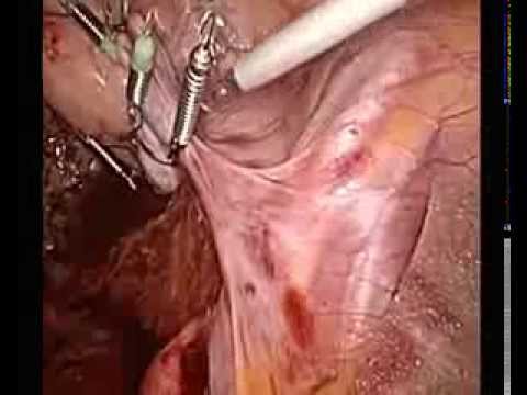 EndoGrab for Uterus Retraction During Sigmoidectomy