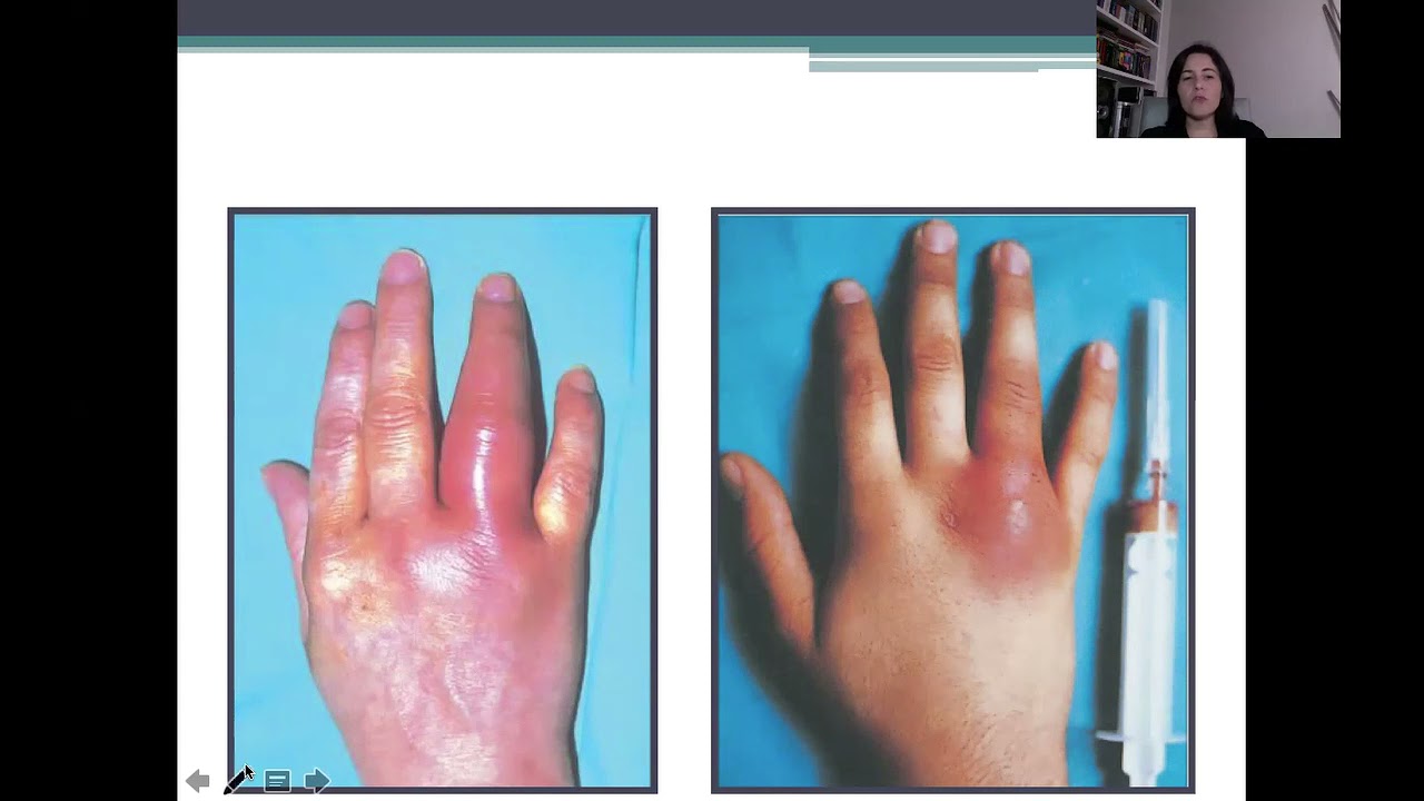 Monoartrites Agudas (Aula – Disciplina Atenção Secundária em Reumatologia - ALO006)