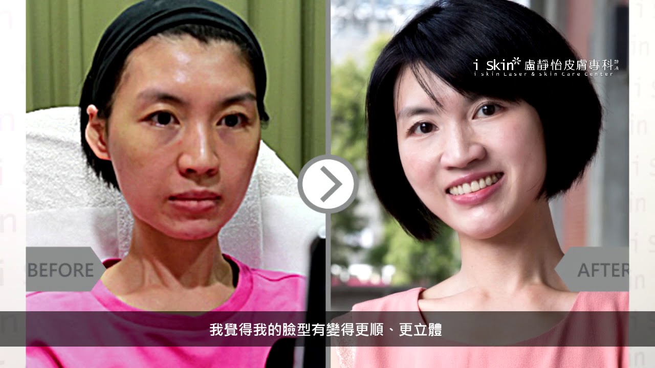 iSkin 盧靜怡皮膚專科診所【玻尿酸】一輩子都要美麗喔 空姐Tiffany