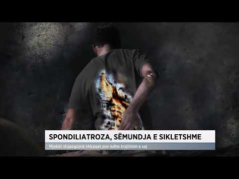 Spondiliatroza, sëmundja e sikletshme