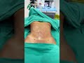 Abdomen Liposuction Immediate Result Shorts