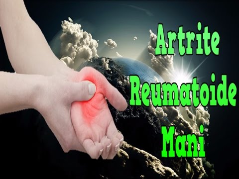 Come trattare collo se fa male Lacido ialuronico per le articolazioni che è