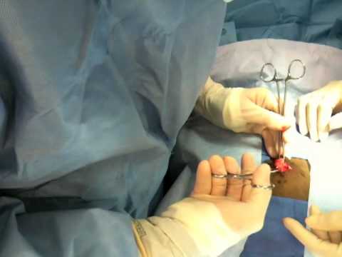 Postpartum Tubal Ligation Minilaparotomy Technique