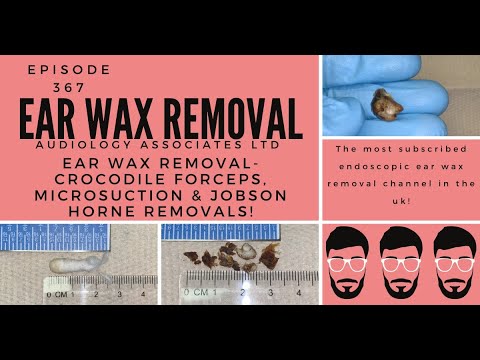 EAR WAX REMOVAL - CROCODILE FORCEPS, MICROSUCTION AND JOBSON HORNE REMOVALS - EP367