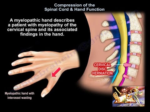 Compression of the Spinal Cord & Hand Function - Everything You Need To Know 