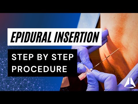 Epidural Insertion Technique | #anesthesiology #anesthesia #epidural