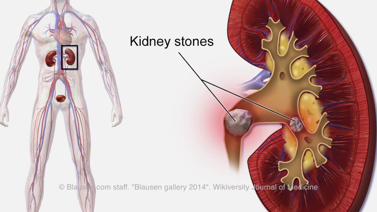 Calcification in Your Body - YouTube