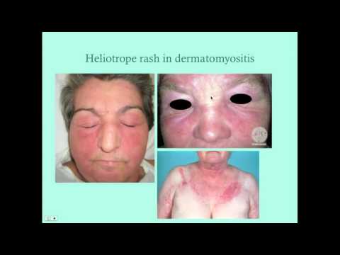 Knistern Gelenke an den Beinen, die Volksmedizin zu tun Dysfunktion des sacroiliac Becken Joint