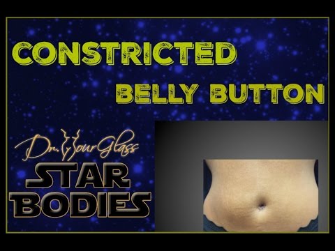 Tummy tuck constricted belly button. Houston, Austin, Dallas, San Antonio