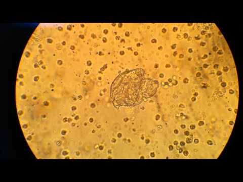 Registri vermi piatti alla persona Il permanganato di potassio può uccidere helminths