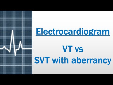 VT versus SVT with aberrancy [Electrocardiogram]