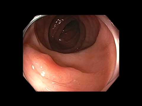 Kolonoskopia: mukozektomia endoskopowa (EMR) płaskiej zmiany okrężnicy poprzecznej