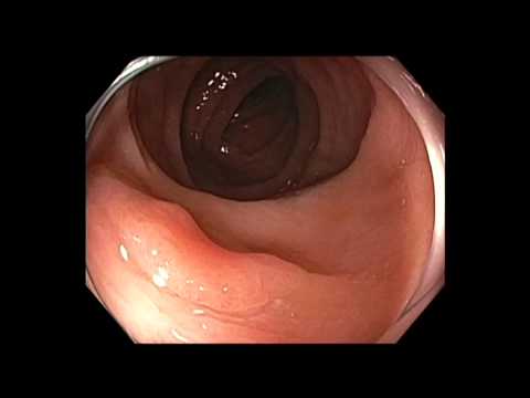 Coloscopie: mucosectomie endoscopique d'une petite lésion plate du côlon transverse et coagulation à l'anse