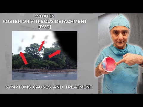 What is Posterior Vitreous Detachment (PVD): Symptoms, Causes, and Treatment