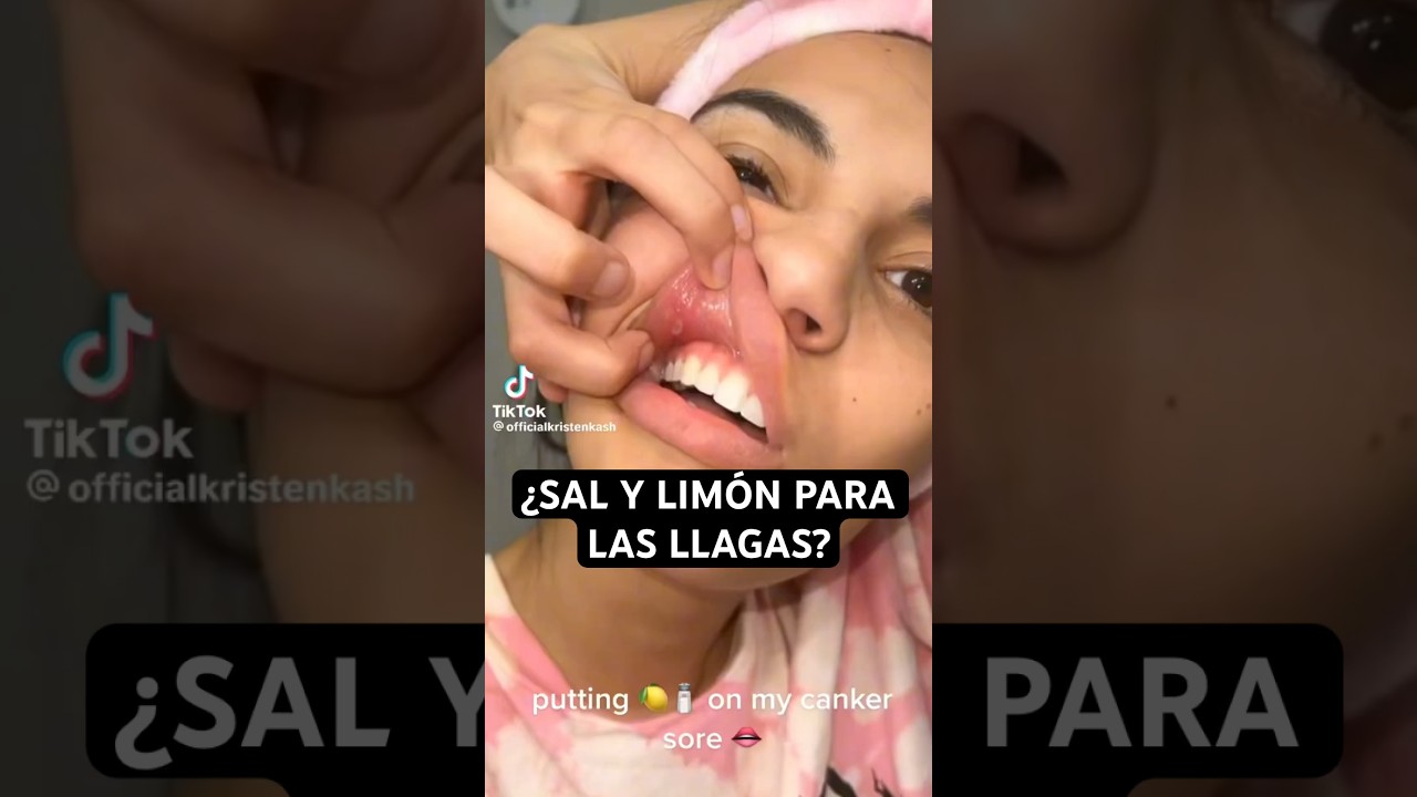 REMEDIO CASERO para las LLAGAS en la BOCA - AHÓRRATE el SUFRIMIENTO