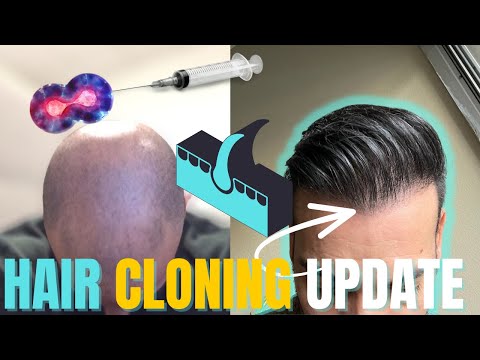 Hair Clone UPDATE - Hair Transplant Network Podcast...
