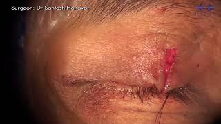 Eyelid Reconstruction Direct Closure