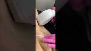 Laser Hair Removal with Venus  velocity