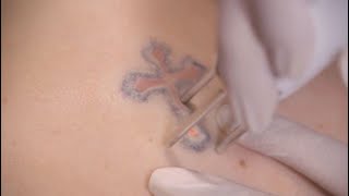 Behind the Scenes of Tattoo Removal