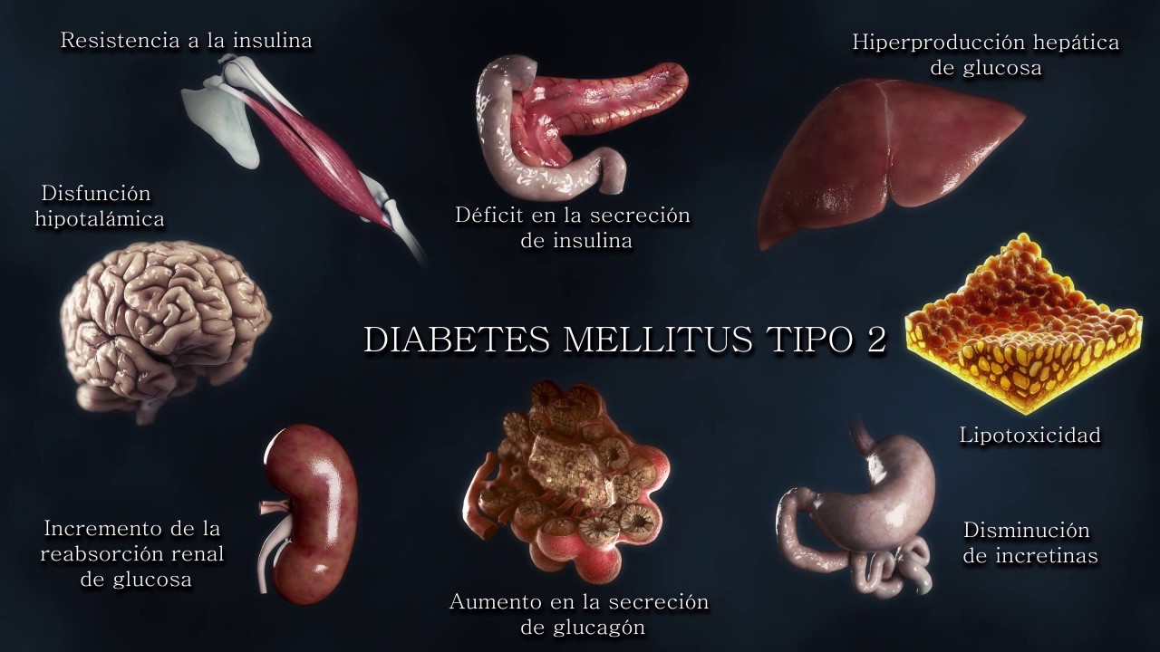 Etiopatogenia de la Diabetes tipo2: de la triada clásica al Octeto Ominoso