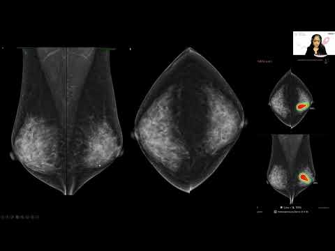 AI in Breast Imaging: An Asian Perspective