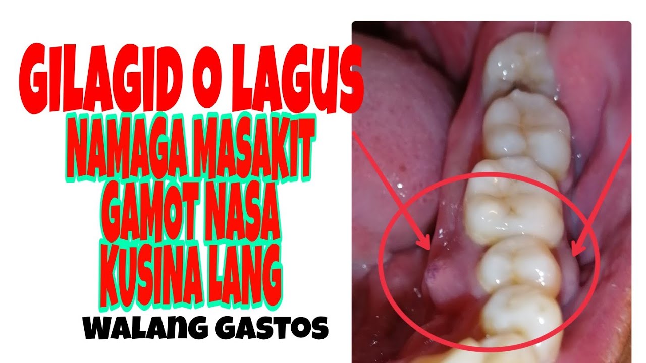 Gilagid o Lagus namaga gamot Na walang gastos na sa kusina lang
