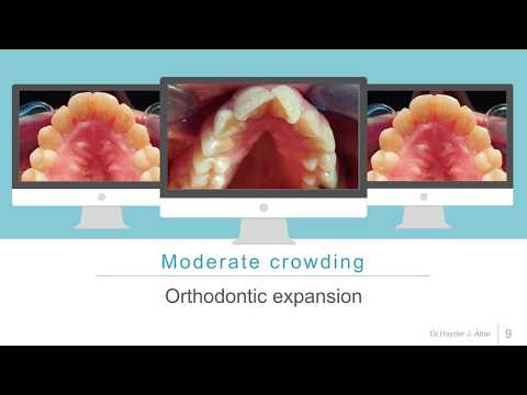 Dental crowding management