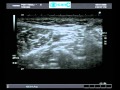 Posterior Tibial Nerve Block (Ultrasound guided)