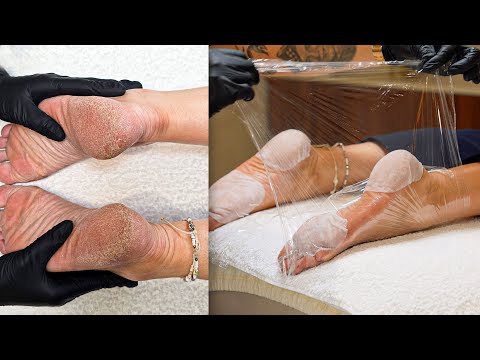 The Most Satisfying Dry Cracked Heel Transformation
