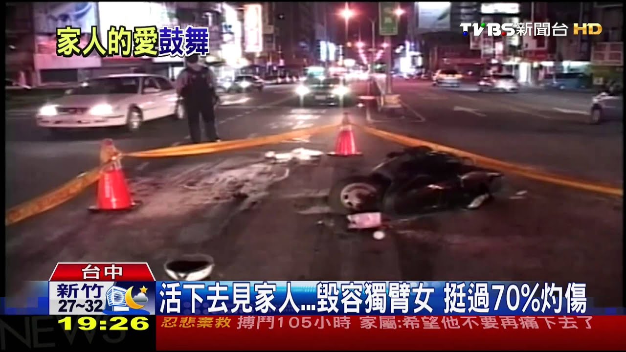 活下去見家人…毀容獨臂女　挺過70%灼傷