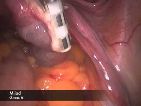 Salpingectomy Before IVF