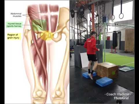 Athletic Pubalgia - Sportska Pubalgia