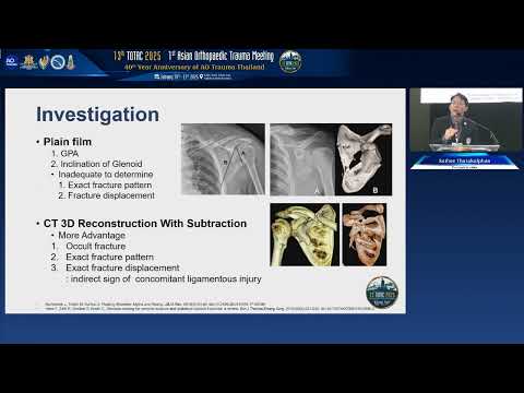 RD20 7 Floating shoulder injury Comminuted clavicle fracture with non displaced glenoid neck fractur