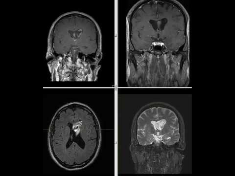 Hydrocephalus - Head MRI