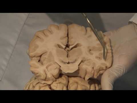 Cortical Localization: Neuroanatomy Video Lab - Brain Dissections
