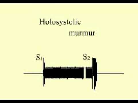 Holosystolic Murmur
