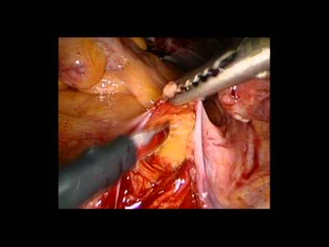 Hystérectomie supracervicale par voie laparoscopique et une hystéro-vaginopexie