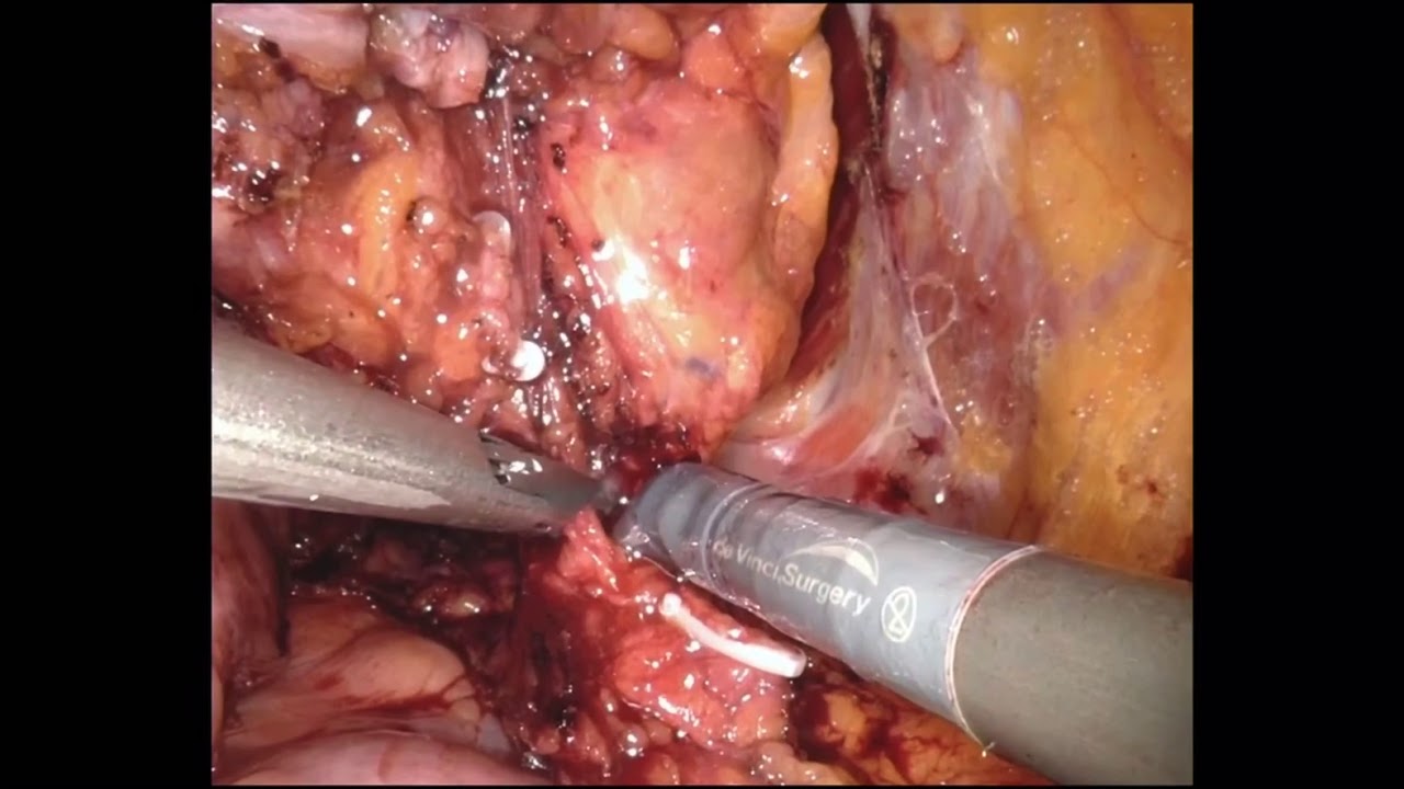 Mesane Kanserinde Robotik Cerrahi (Robotik Sinir Koruyucu Radikal Sistektomi)Prof.Dr.Ali Fuat Atmaca