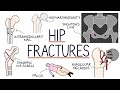 Understanding Hip Fractures and Hip Surgery