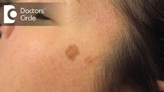How to get rid of dark patches on face? - Dr. Rashmi Ravindra
