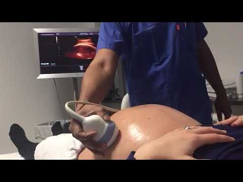 Understanding how to do soft touch ECV for breech. Would you like this experience?#ecv #pregnancy 